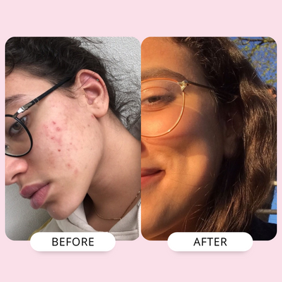 Hyperpigmentation Correction Duo