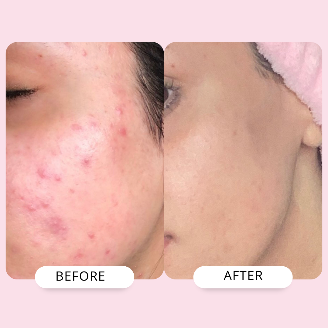 Hyperpigmentation Correction Duo